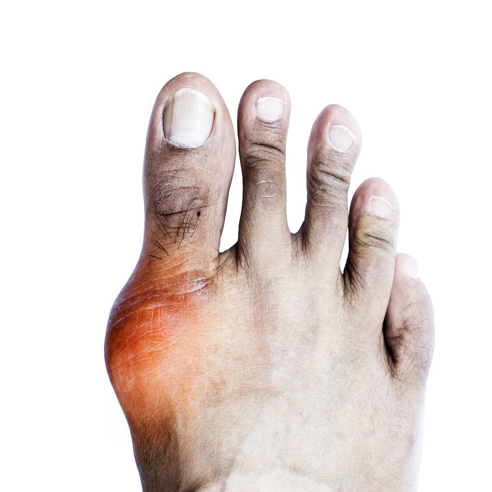 az ujjak alatti láb artrózisa kezelés ha a karok és a lábak ízületei fájnak