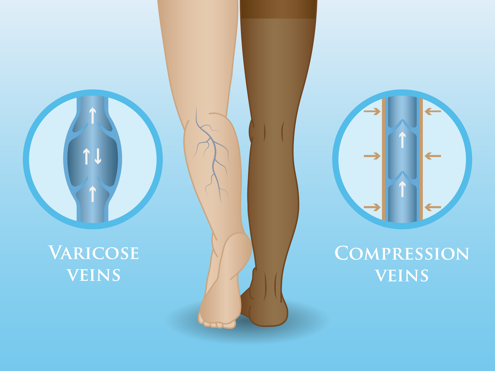 meg lehet-e operálni a varikózisokat a lábakon?