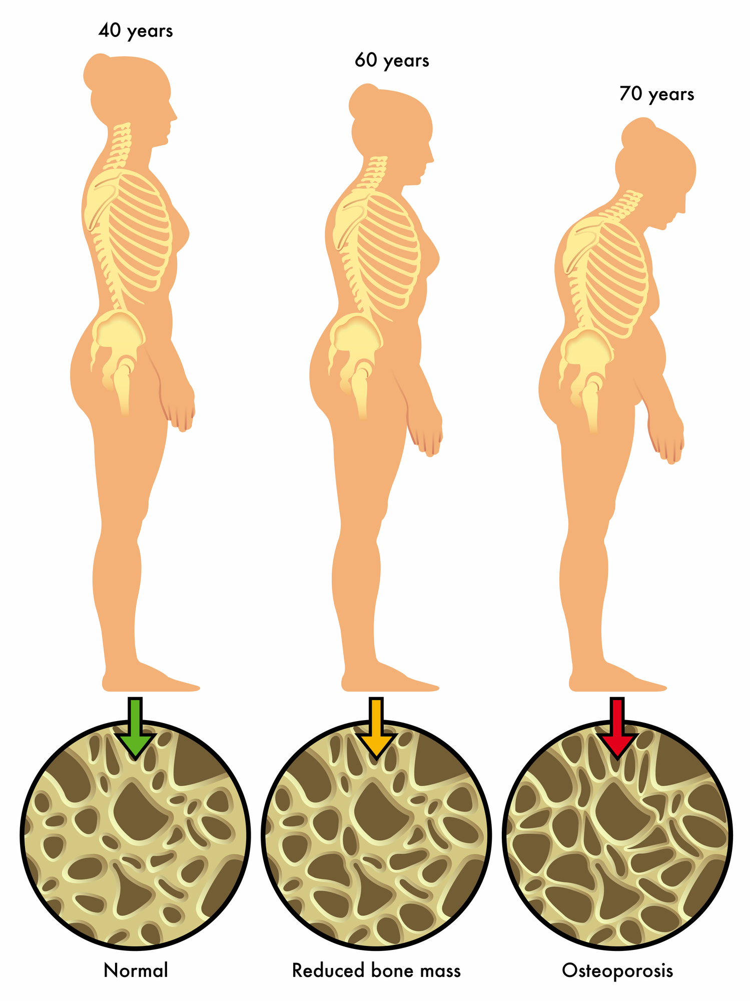 Csontritkulás - amit a betegségről tudni kell - Dr. Zátrok Zsolt blog
